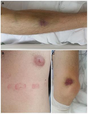 Case Report: A Case of COVID Vaccine-Induced Thrombotic Thrombocytopenia Manifested as Pulmonary Embolism and Hemorrhagia. A First Reported Case From Slovakia
